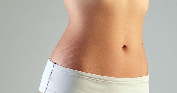 Stretch Marks permanent solution