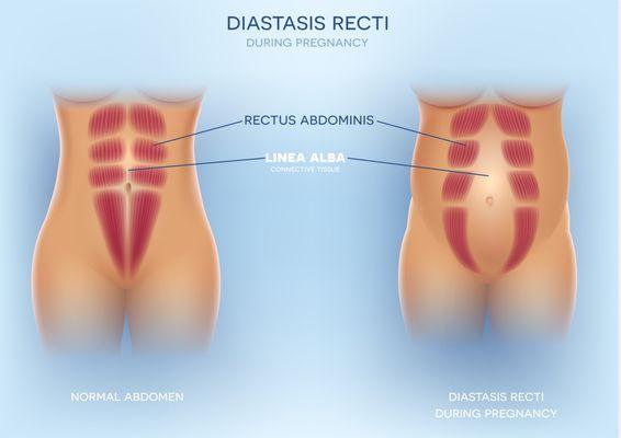 Diastasis Recti affects more than 40% of women post baby.  PearlPhysio can help you correct this with a safe postpartum program.