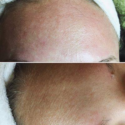 Microneedling Facial and a Peptide mask: Smoothing her fine lines from her forehead.