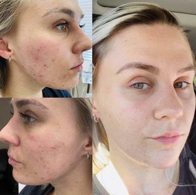 Chemical peel series before and after