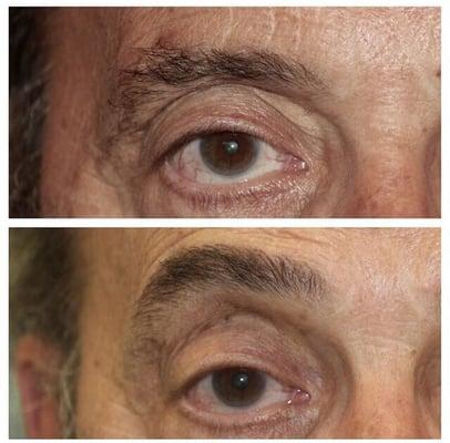 Before and after permanent stroke eyebrows.