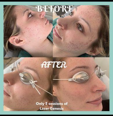 just 2 sessions of laser genesis. It's amazing for acne treatment!