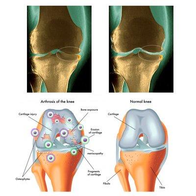 Stem Cell therapy has the ability assist in tissue growth