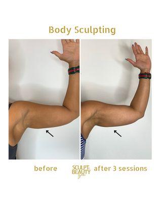 Body Sculpting (Arm Session)