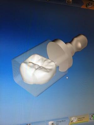 3D teeth pictures to crowns on the spot