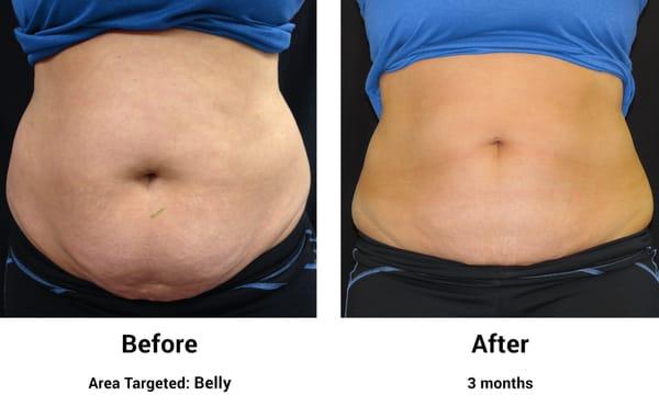 Before/After Belly