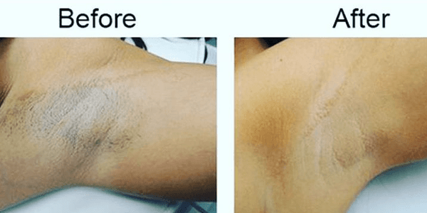 Permanent Armpit Hair Removal