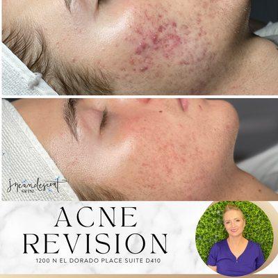 Acne skin revision