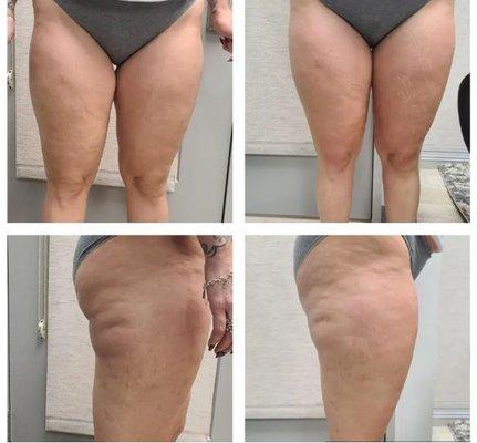 Burn off fat and decrease signs of cellulite with body contouring