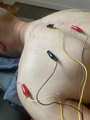 Dry needling for shoulder deficits