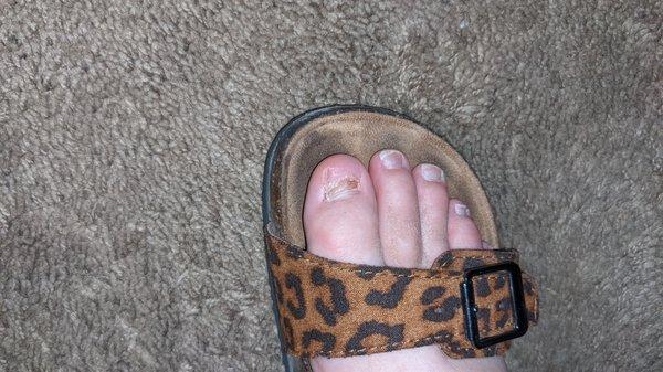 Toenail after