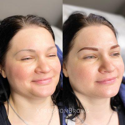 Brow correction