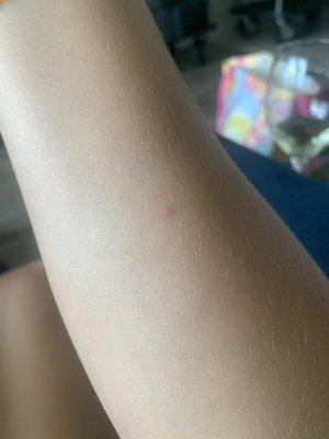 Bed bug bites