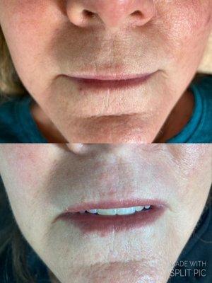 Plasma Fibroblast for Wrinkles  around mouth