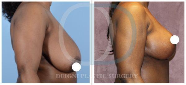 Breast Reduction