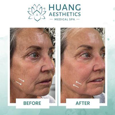 Skin tightening treatment is an option for patients seeking facial rejuvenation.