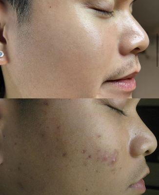 Before/After: Chemical Peel Series & Customized Homecare Regimen