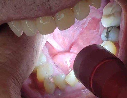 lacerated tongue tissue from bone spur.  Spur is under and rear of last molar.