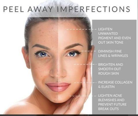 We offer Chemical peel packages