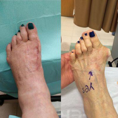 Severe Bunion - Before and After