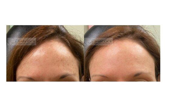 Laser to treat brown spots