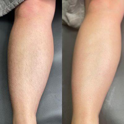 Before and after leg wax!