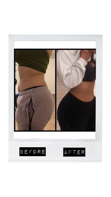 Cryolipolysis ( 1 sessions ) & Laser Lipo