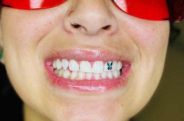 Teeth whitening and tooth gems