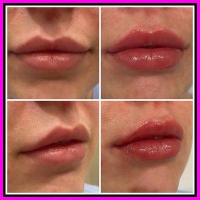 Before and after lip filler