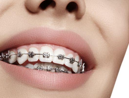 Free Braces Consultation