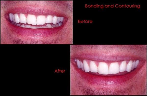 A little bonding and contouring of teeth can often make a huge difference as Dr. Rohwer did with this patient's smile.