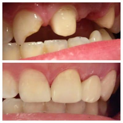 replacement of a missing front tooth with a porcelain bridge and a filling due to trauma from a fall