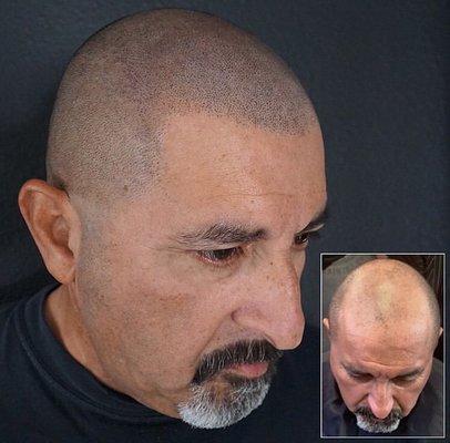 Scalp Micropigmentation