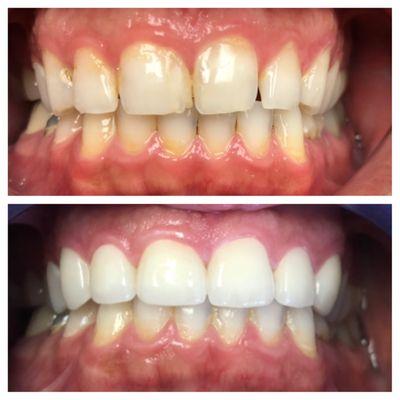 Check this amazing transformation done by Dr. Akhavan at Reflection Dental.