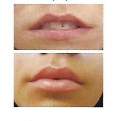 Beautiful, Full Lips. B&A- Lip Filler