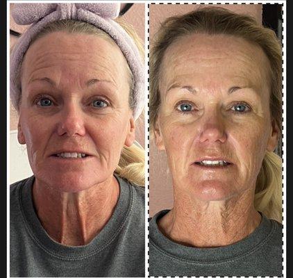 Before and after a non invasive Cryo facelift facial & 6min skin tightening session.