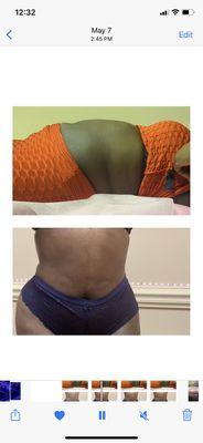 Before & after Cavitation & skin tightening treatment