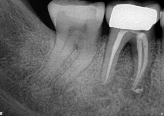 Same case immediately after treatment.