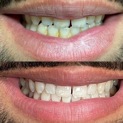 Teeth cleaning & whitening