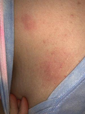 Bed bug bites on my chest