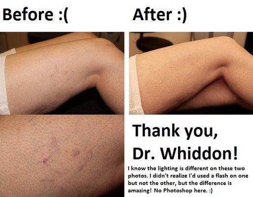 Before and after images of the spider veins on my upper thigh that Dr. Whiddon treated. THANK YOU!!