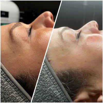 Before and After Face Lift/ Firming Facial