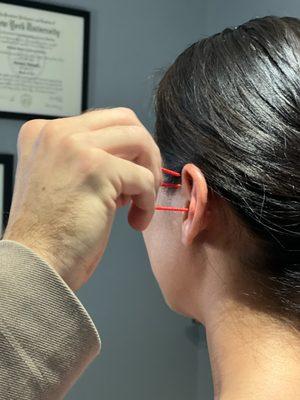 Auricular acupuncture