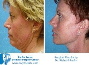 Total Make Over Face Lift Appleton WI with Dr. Parfitt