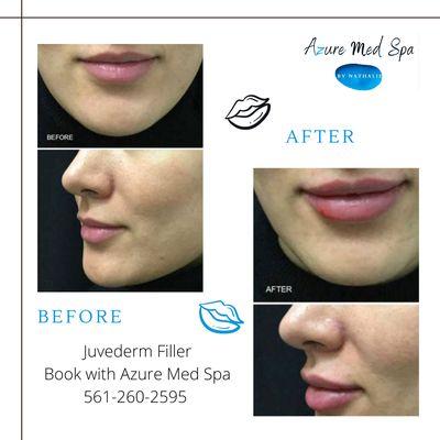 Juvederm