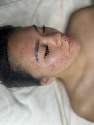 CUSTOM ACNE FACIAL