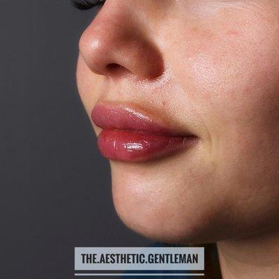 Beautiful lips by our talented injector Cory! Book with him today!