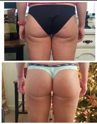 Traditional liposuction correction: Cleaned up the large indentions and smoothed out cellutlite and saddle bags. 40yr. old mother of two.