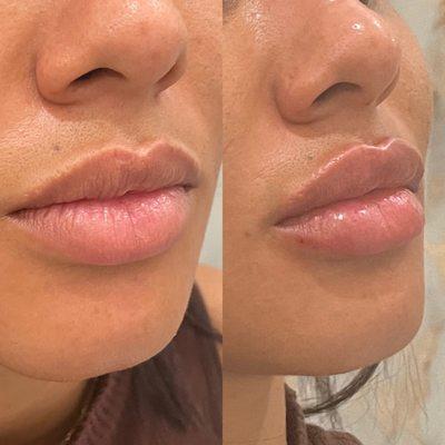 Lip Filler 
 Before & After