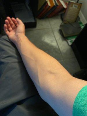 Normal arm